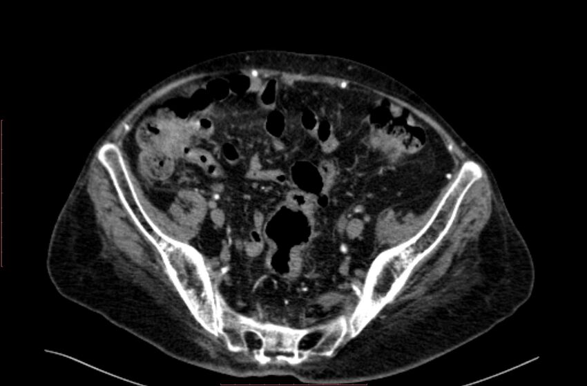 Abdominal aortic interposition tube graft and aneurysm thrombosis (Radiopaedia 71438-81857 Axial C+ arterial phase 178).jpg