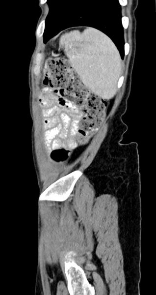 File:Abdominal wall and retroperitoneal tuberculosis (Radiopaedia 88137-104729 Sagittal C+ portal venous phase 26).jpg