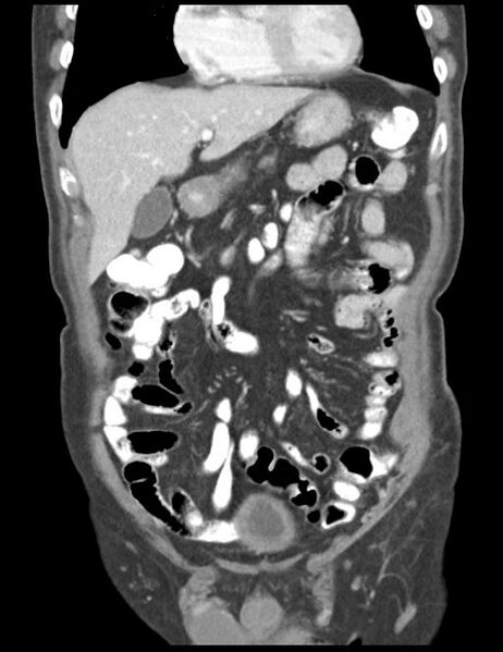 File:Abdominal wall metastasis from colorectal carcinoma (Radiopaedia 31016-31717 Coronal C+ portal venous phase 15).jpg