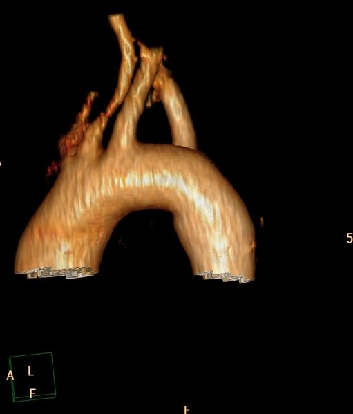 File:Aberrant right subclavian artery (Radiopaedia 67135-76475 volume rendering C+ arterial phase 9).jpg