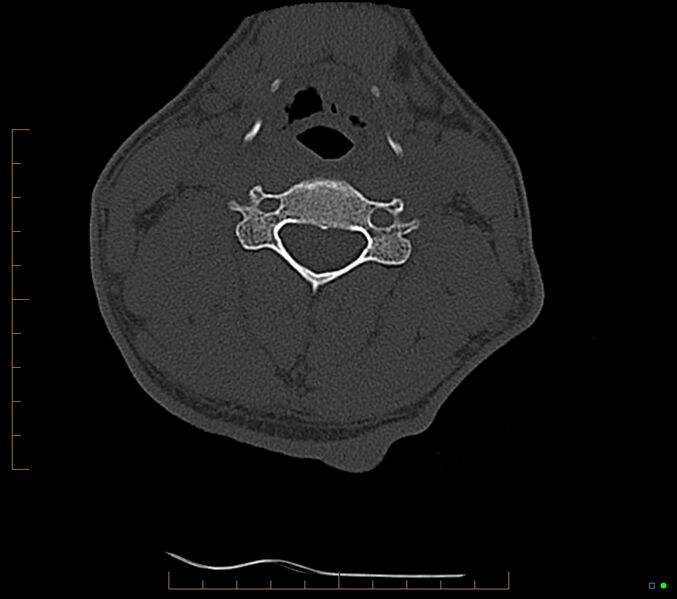 File:Accessory articulation of cervical transverse processes (Radiopaedia 82715-96933 Axial non-contrast 67).jpg