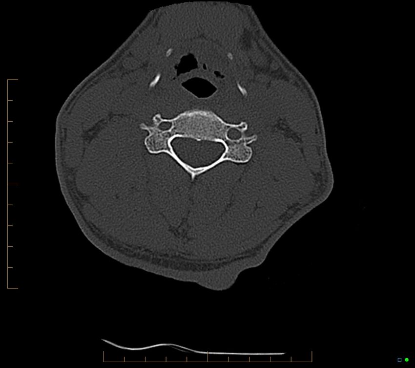 Accessory articulation of cervical transverse processes (Radiopaedia 82715-96933 Axial non-contrast 67).jpg