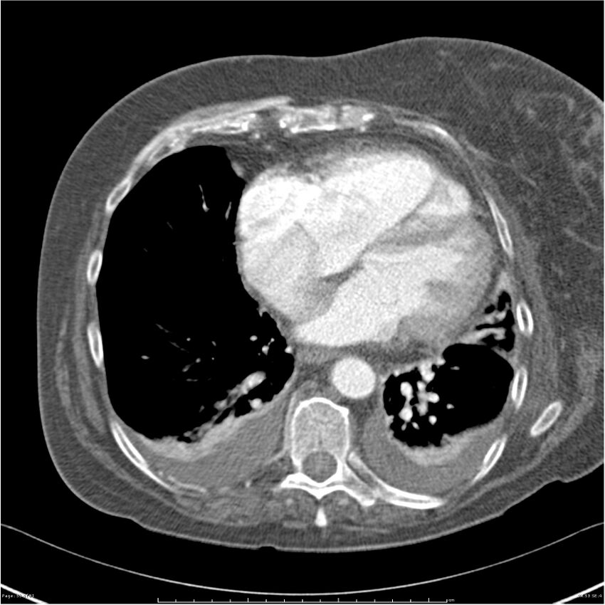 Acute-on-chronic pulmonary emboli (Radiopaedia 27925-28169 C+ CTPA 53).jpg