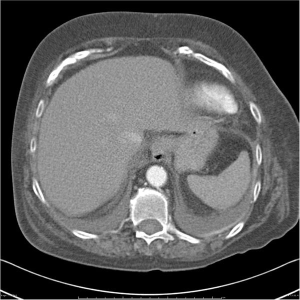 File:Acute-on-chronic pulmonary emboli (Radiopaedia 27925-28169 C+ CTPA 73).jpg