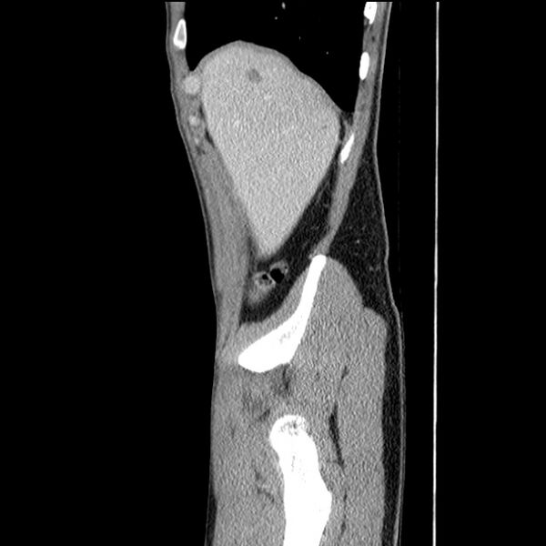 File:Acute appendicitis (Radiopaedia 27049-27227 Sagittal C+ portal venous phase 10).jpg