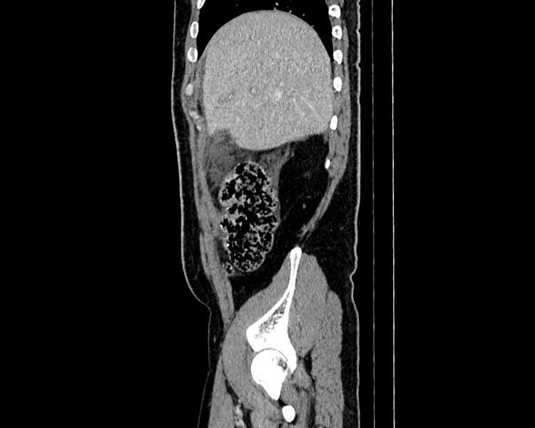 File:Acute cholecystitis (Radiopaedia 53216-59182 Sagittal C+ portal venous phase 3).jpg