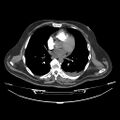 Acute heart failure (CT) (Radiopaedia 79835-93075 Axial C+ arterial phase 22).jpg