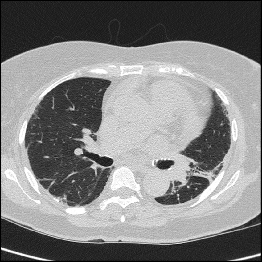 Acute interstitial pneumonitis (Radiopaedia 45404-49453 Axial lung window 41).jpg