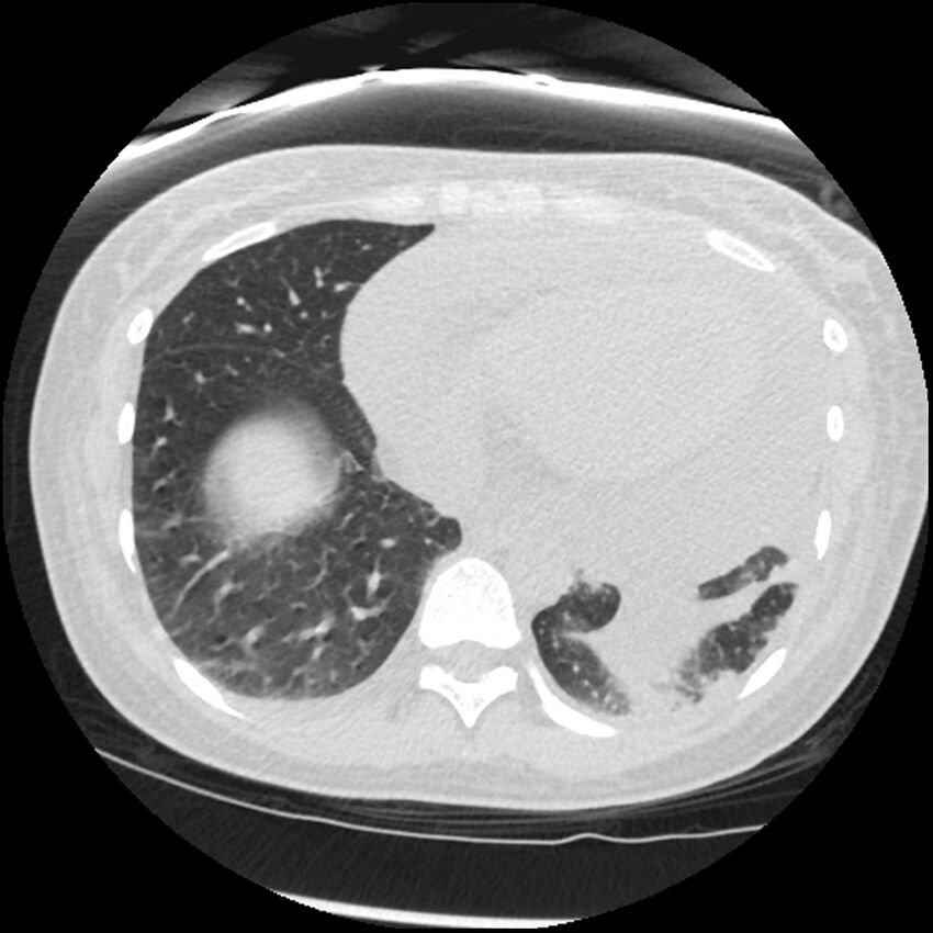 Acute lupus nephritis (Radiopaedia 45832-50107 Axial lung window 72).jpg