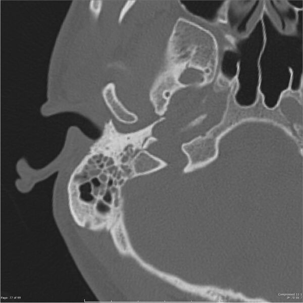 File:Acute otomastoiditis (Radiopaedia 28276-28512 Axial PTB bone window reformat 57).jpg