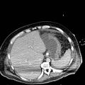 Acute pancreatic necrosis (Radiopaedia 13560-18501 Axial C+ portal venous phase 21).jpg