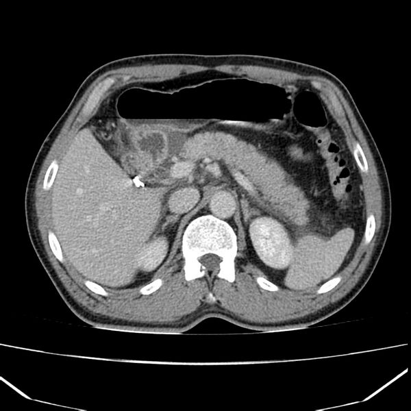 File:Acute pancreatitis (Radiopaedia 22572-22596 Axial C+ portal venous phase 22).jpg