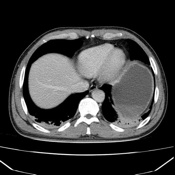 File:Acute pancreatitis (Radiopaedia 22572-22596 Axial C+ portal venous phase 8).jpg