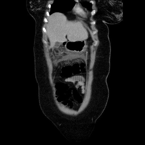 File:Acute pancreatitis (Radiopaedia 69236-79012 Coronal C+ portal venous phase 59).jpg