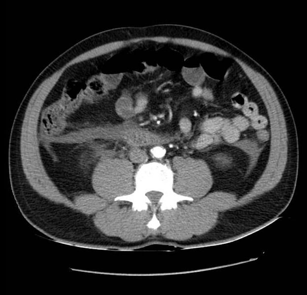 File:Acute pancreatitis - Balthazar E (Radiopaedia 23080-23110 Axial C+ arterial phase 40).jpg