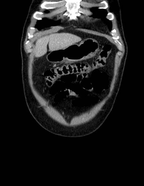 File:Acute pancreatitis - Balthazar E (Radiopaedia 23080-23110 Coronal C+ portal venous phase 7).jpg