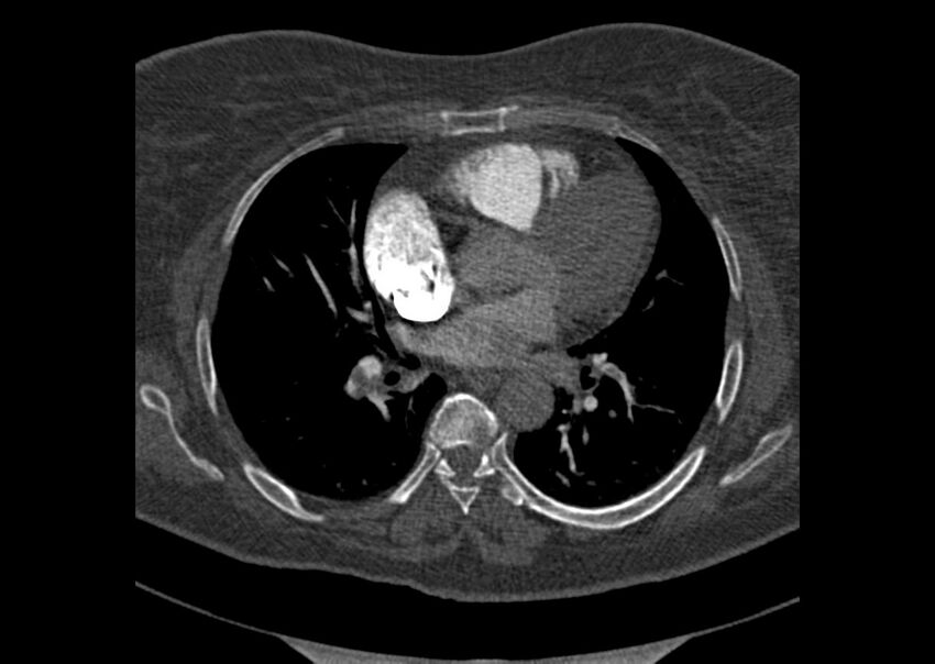 Acute pulmonary embolism (Radiopaedia 29938-30466 Axial C+ CTPA 106).jpg