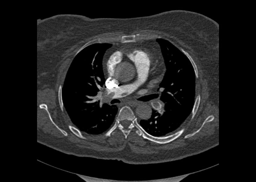 Acute pulmonary embolism (Radiopaedia 29938-30466 Axial C+ CTPA 63).jpg