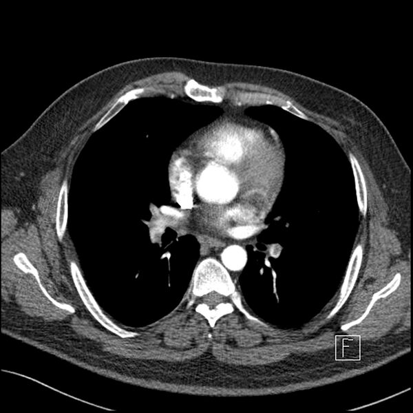 File:Acute pulmonary embolism with pulmonary infarct (Radiopaedia 73062-83768 Axial C+ CTPA 39).jpg