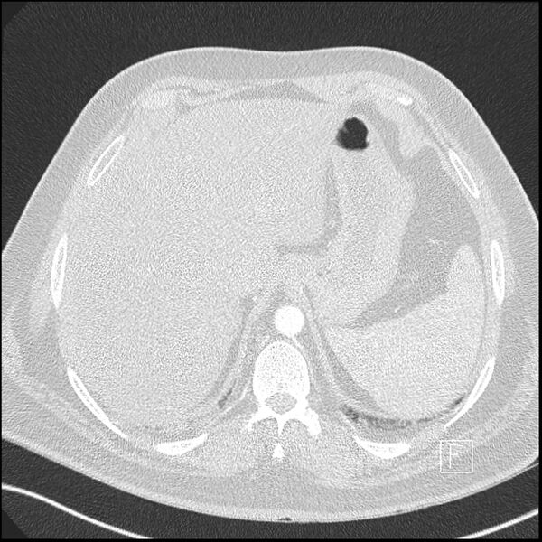 File:Acute pulmonary embolism with pulmonary infarct (Radiopaedia 73062-83768 Axial lung window 28).jpg