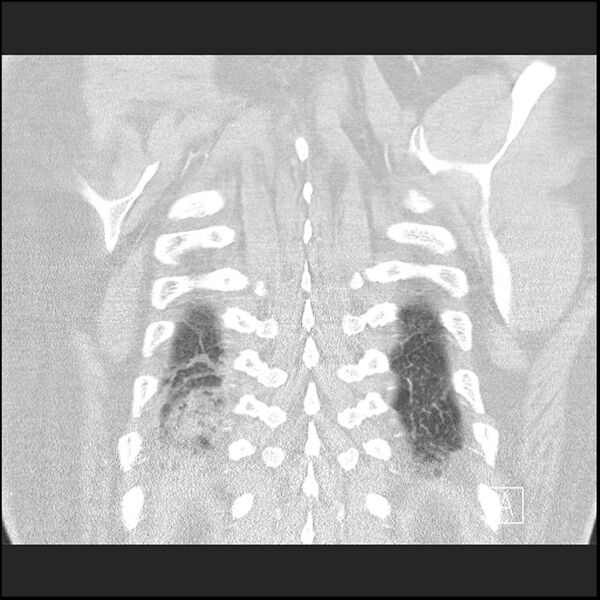 File:Acute pulmonary embolism with pulmonary infarct (Radiopaedia 73062-83768 Coronal lung window 69).jpg