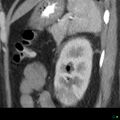 Acute pyelonephritis and emphysematous pyonephrosis (Radiopaedia 27893-28128 renal cortical phase 5).jpg