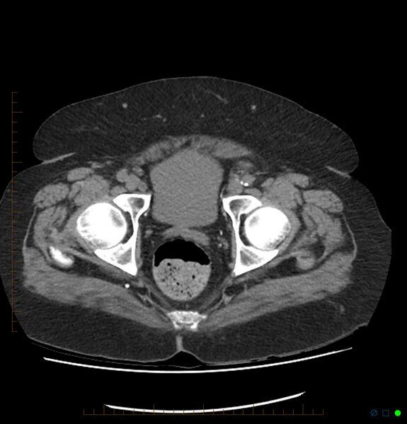File:Acute renal failure post IV contrast injection- CT findings (Radiopaedia 47815-52557 Axial non-contrast 76).jpg