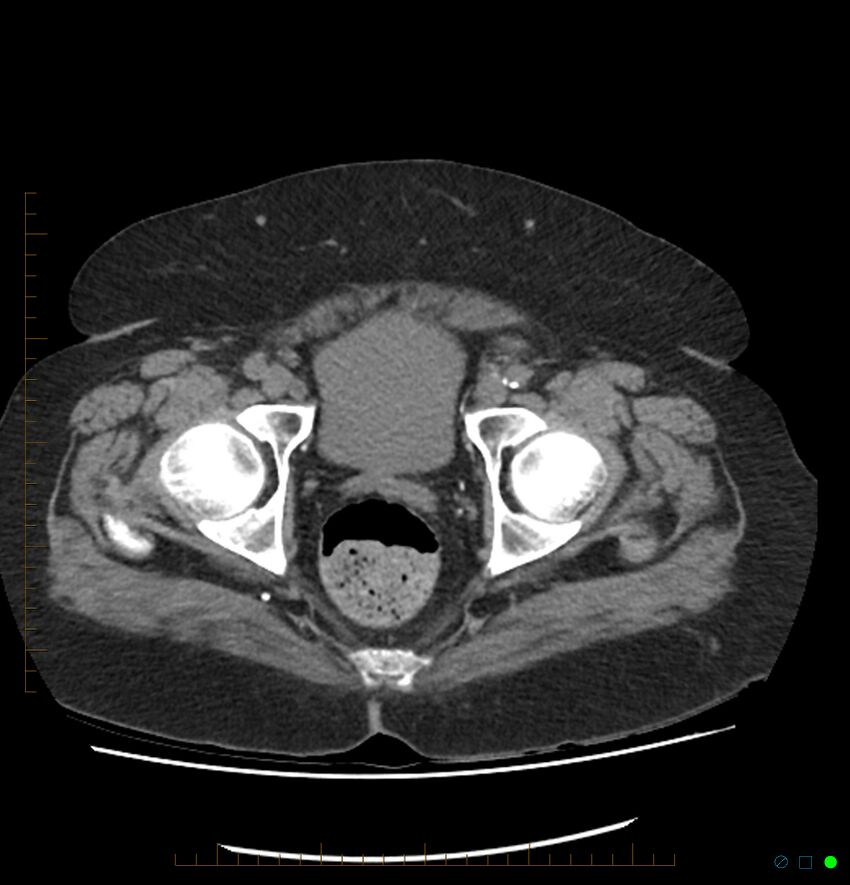 Acute renal failure post IV contrast injection- CT findings (Radiopaedia 47815-52557 Axial non-contrast 76).jpg