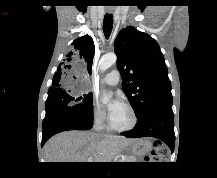 File:Acute right lung abscess (Radiopaedia 34806-36258 Coronal C+ arterial phase 34).jpg