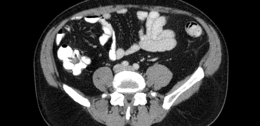 Acute sigmoid colon diverticulitis (Radiopaedia 55507-61976 Axial C+ portal venous phase 51).jpg