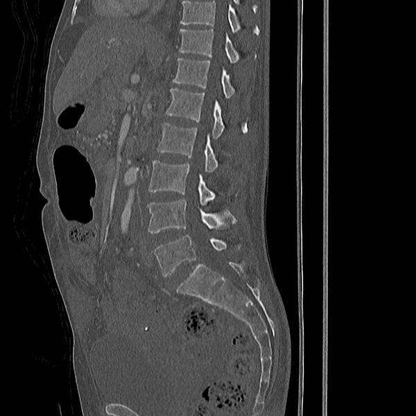File:Acute vertebral body compression fractures (Radiopaedia 31757-32693 Sagittal bone window 28).jpg