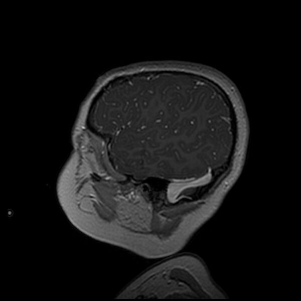 File:Adamantinomatous craniopharyngioma (Radiopaedia 77407-89529 H 19).jpg