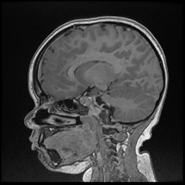 File:Adamantinomatous craniopharyngioma (Radiopaedia 77407-89529 Sagittal T1 C+ 57).jpg