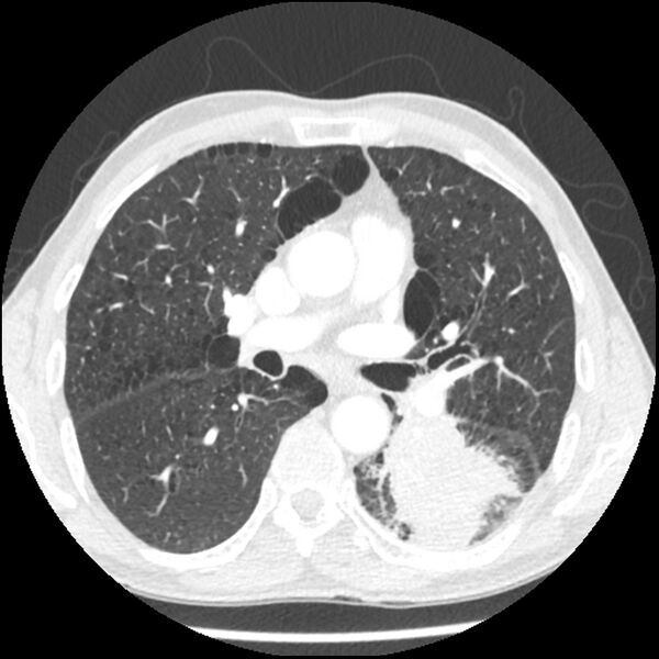 File:Adenocarcinoma of the lung - micropapillary predominant (Radiopaedia 42446-45563 C 39).jpg