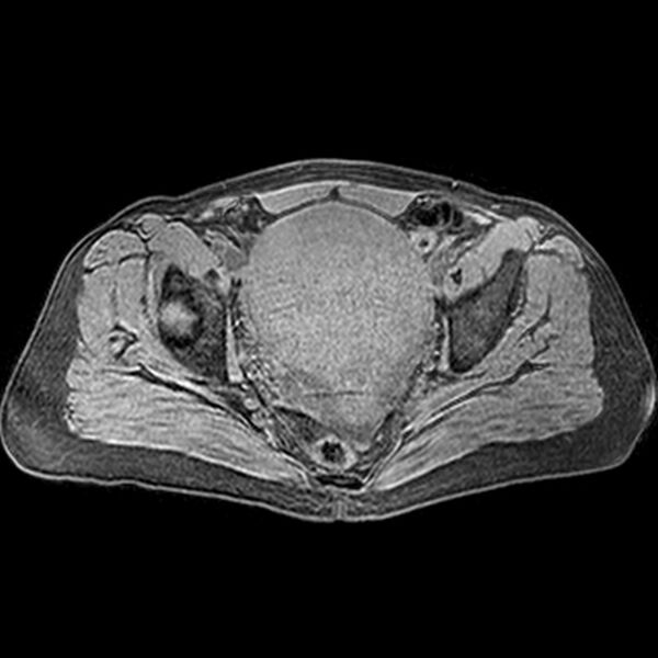 File:Adenomyoma of the uterus (huge) (Radiopaedia 9870-10438 Axial T1 fat sat 14).jpg