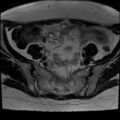 Adenomyosis and endometriotic cysts (Radiopaedia 82300-96367 Axial T2 27).jpg