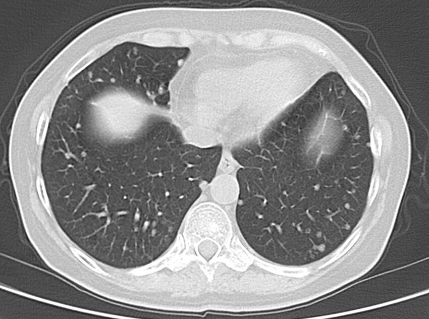 Adenosquamous lung carcinoma (Radiopaedia 22035-22030 lung window 46).jpg