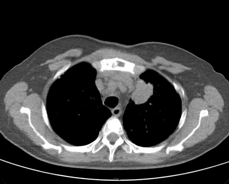 File:Adenosquamous lung carcinoma (Radiopaedia 22035-22030 non-contrast 20).jpg