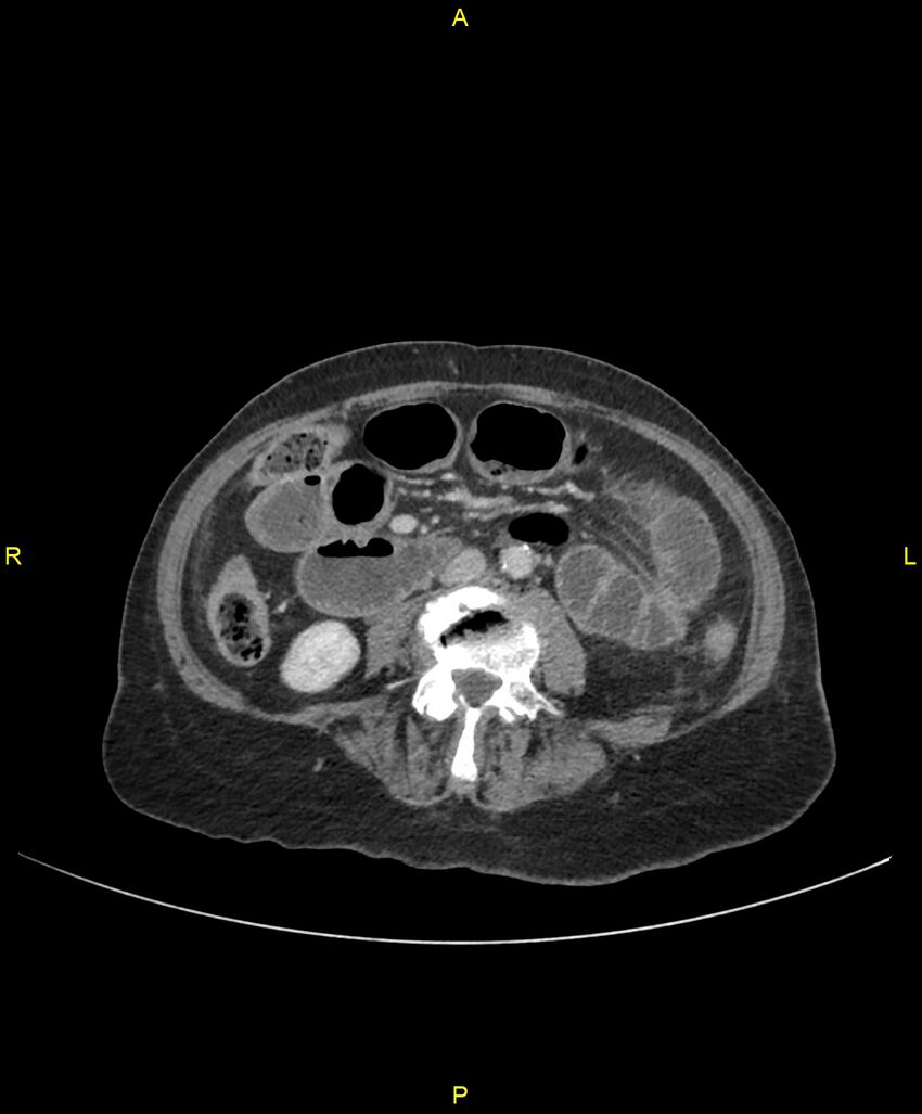 Adhesional small bowel obstruction (Radiopaedia 85402-101024 Axial C+ portal venous phase 153).jpg