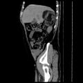 Adrenal myelolipoma (Radiopaedia 41843-44834 Sagittal non-contrast 5).jpg
