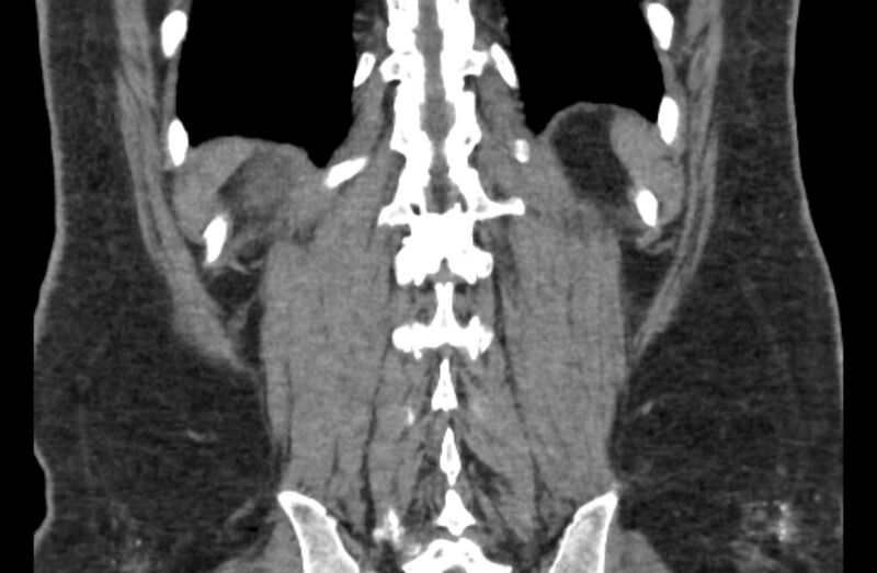 File:Adrenal myelolipoma (Radiopaedia 65240-74253 Coronal non-contrast 63).jpg