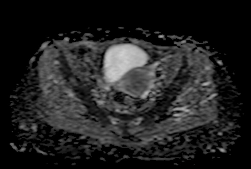 File:Adult granulosa cell tumor of the ovary (Radiopaedia 71581-81950 Axial ADC 13).jpg