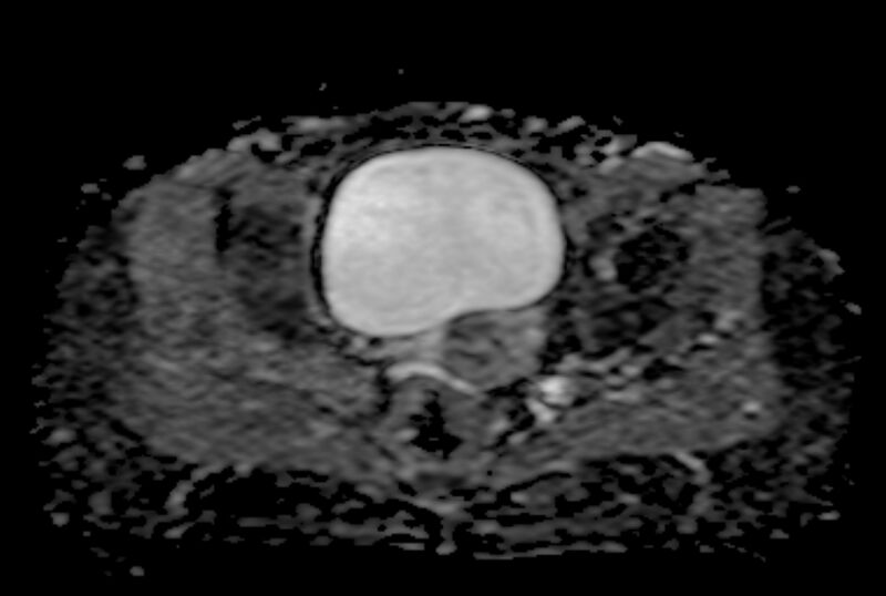 File:Adult granulosa cell tumor of the ovary (Radiopaedia 71581-81950 Axial ADC 18).jpg