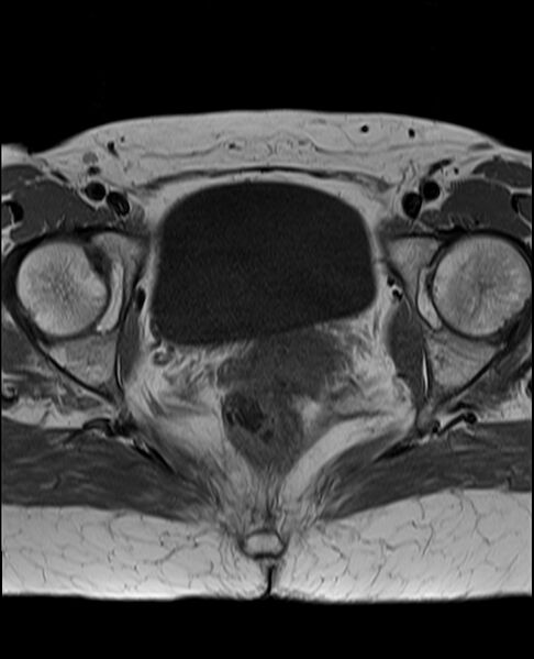 File:Adult granulosa cell tumor of the ovary (Radiopaedia 71581-81950 Axial T1 20).jpg