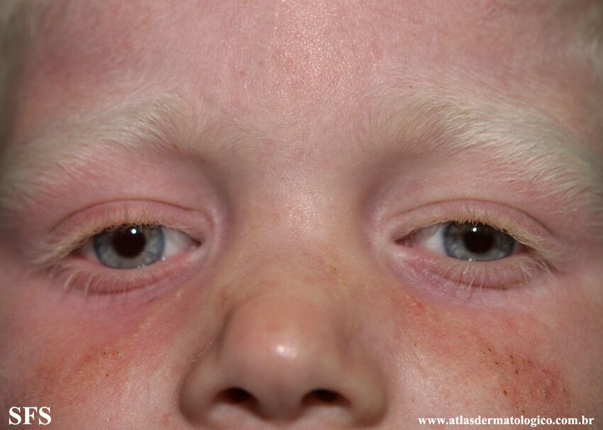 Albinism (Dermatology Atlas 6).jpg