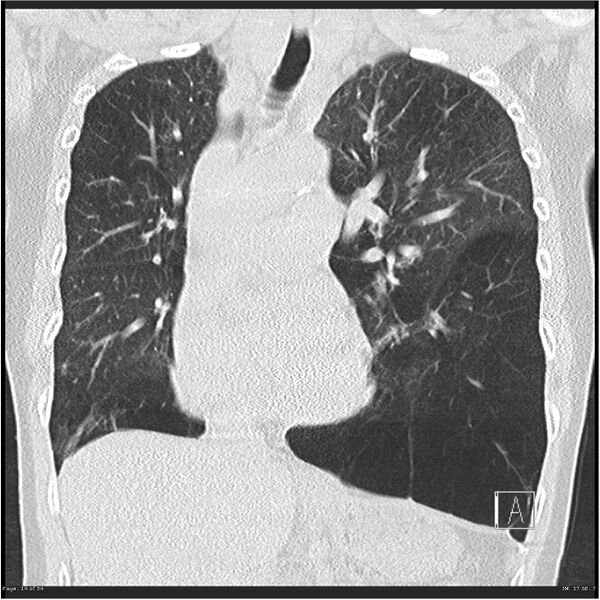 File:Alpha-1-antitrypsin deficiency (Radiopaedia 26537-26678 Coronal lung window 14).jpg