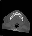Ameloblastoma (Radiopaedia 18115-17901 Axial bone window 11).jpg