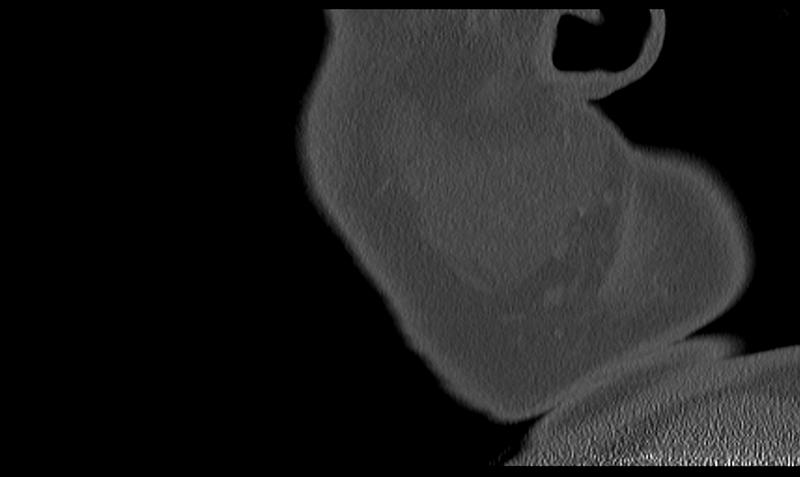 File:Ameloblastoma (Radiopaedia 33677-34806 Sagittal bone window 59).png