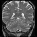 Amnestic syndrome secondary to hypoxic brain injury (Radiopaedia 24743-25004 F 1).jpg