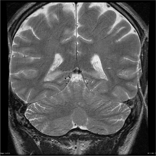 File:Amnestic syndrome secondary to hypoxic brain injury (Radiopaedia 24743-25004 F 1).jpg